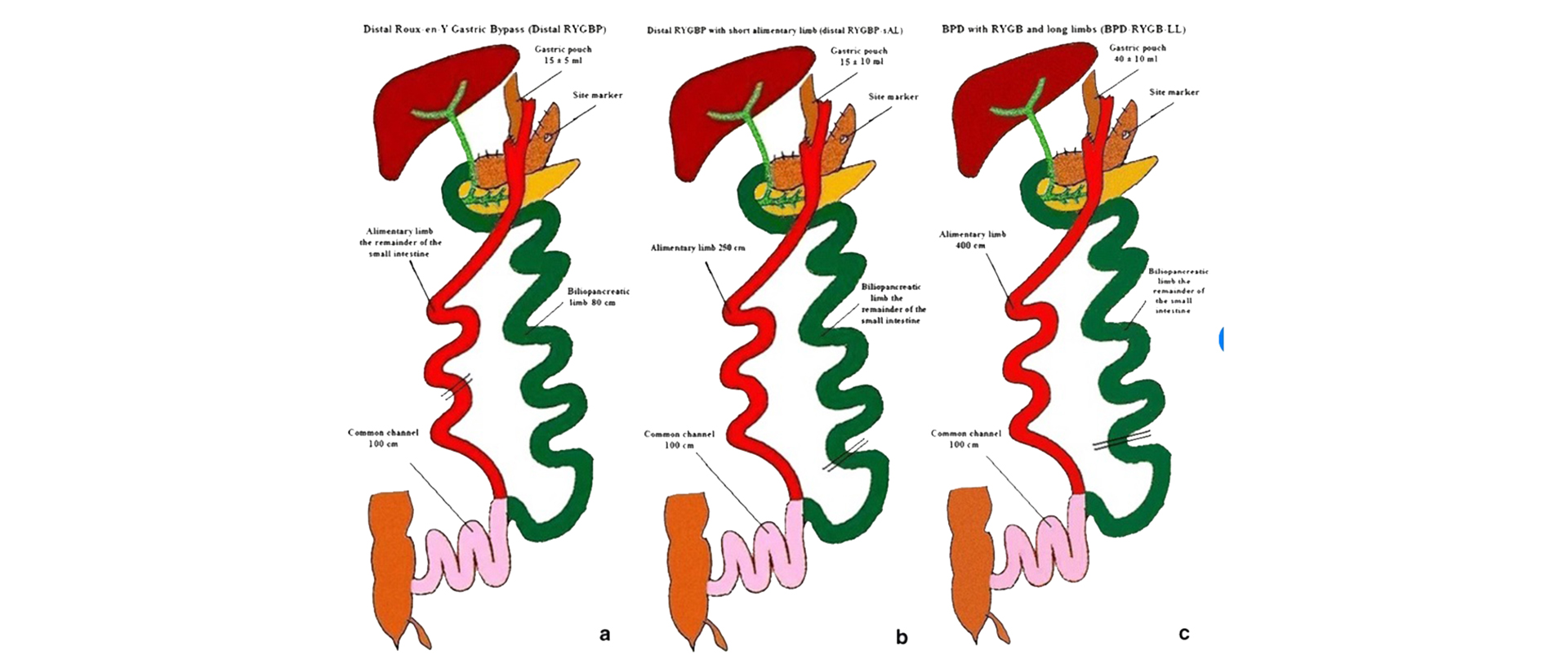 Gastrik Bypass Revizyonu
